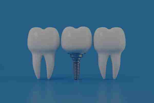 Titanium MIM dental implants
